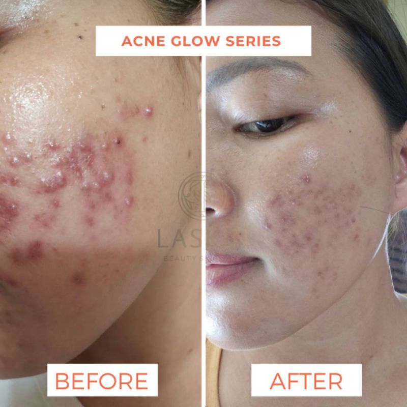 LASKIN PAKET ACNE GLOW SERIES ( FREE POUCH )-8