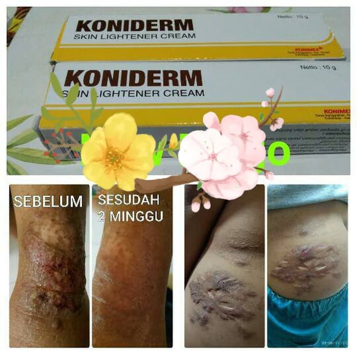 KONIDERM KREM U/KELOID SCAR DAN WAJAH PUTIH