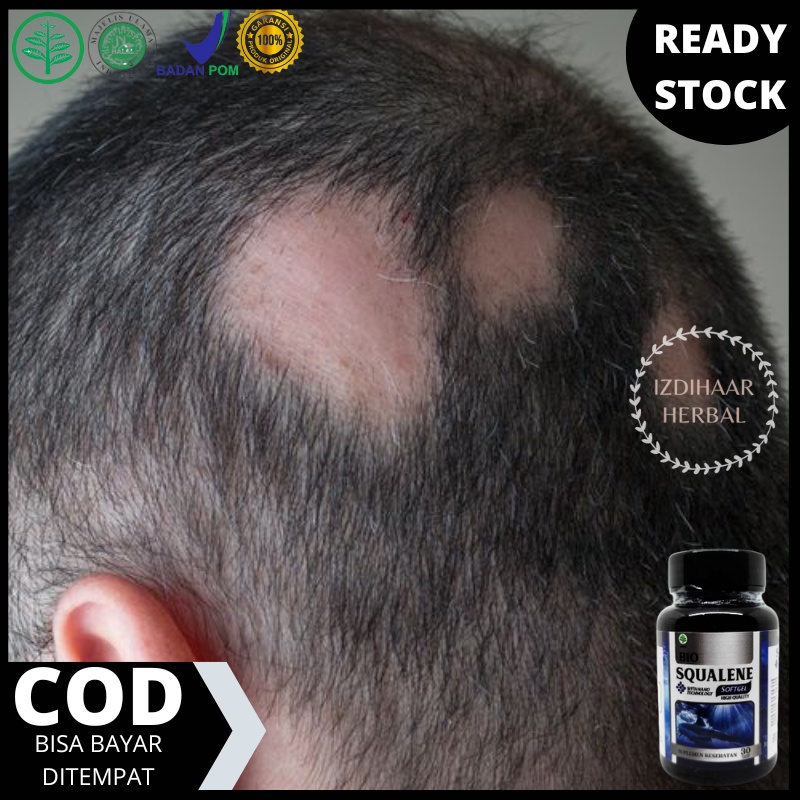 Obat Alopecia Areata, Obat Auto Imun, Obat Botak Pitak, Obat Kebotakan Pada Rambut, Rambut Botak Koi