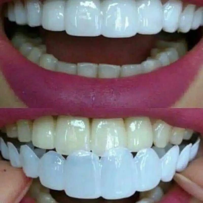 Laristerus79 Snap on smile veneers gigi palsu original TANPA  DUS