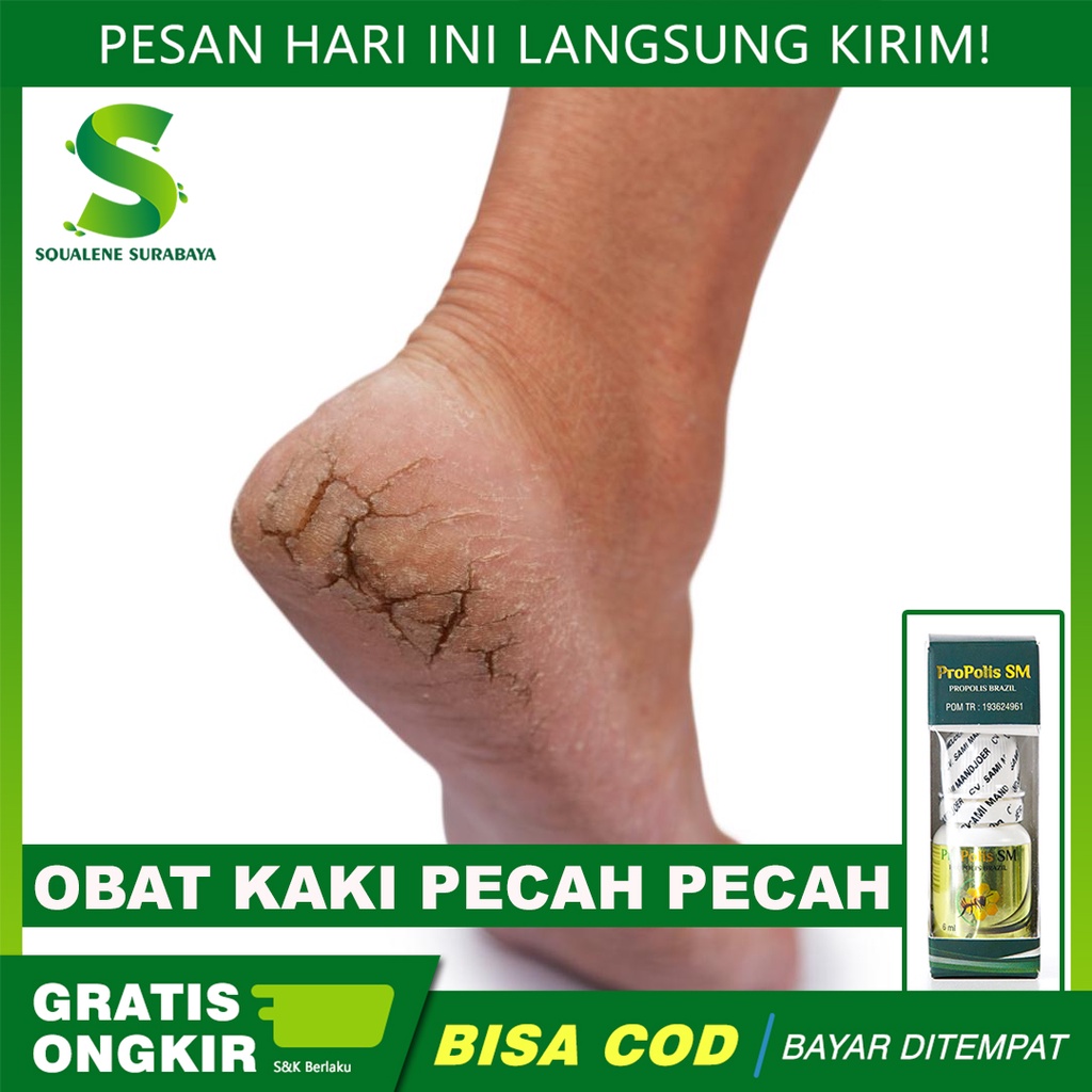 Jual Obat Kaki Pecah-Pecah - Telapak Kaki Rayapan - Kaki Pecah Pecah ...