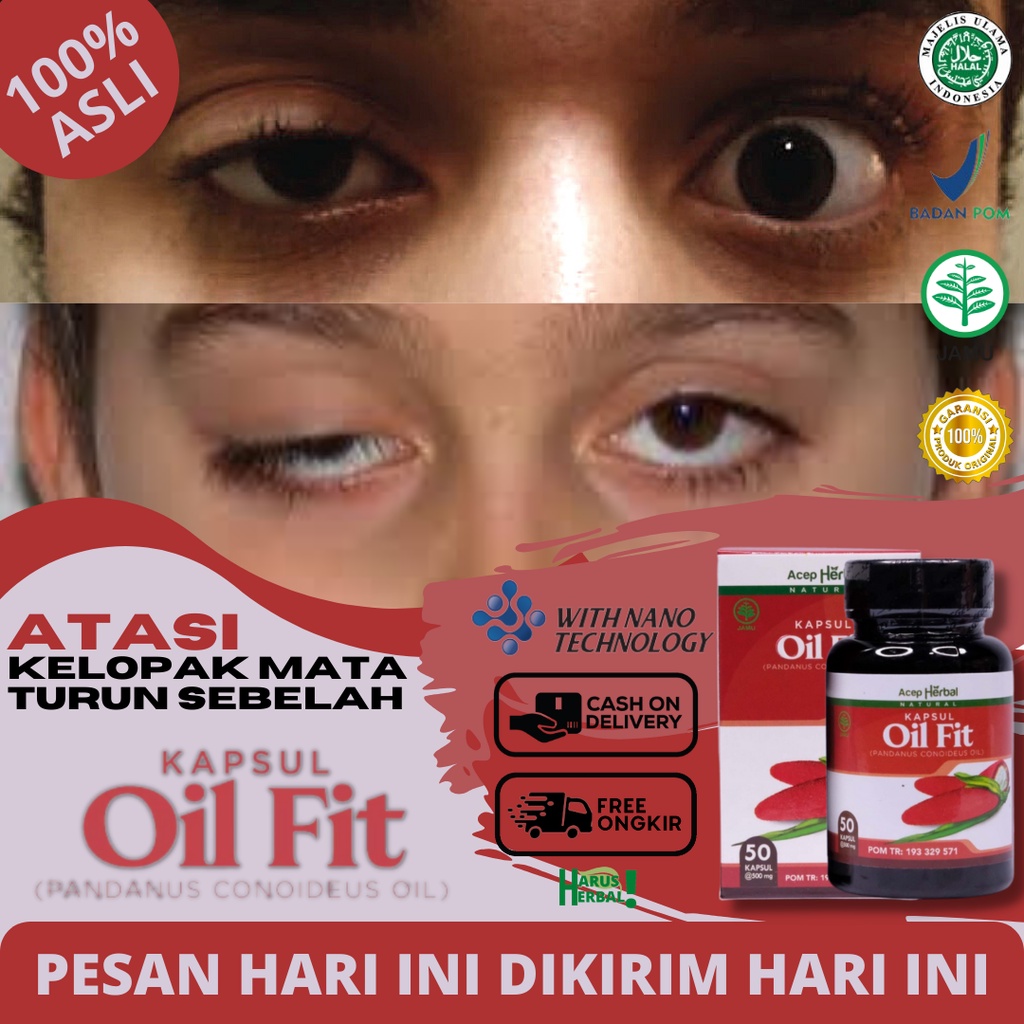 Obat Kelopak Mata Turun Sebelah, Penyakit Mata Ptosis, Obat Mata Sipit Sebelah, Obat Kelopak Mata Ke