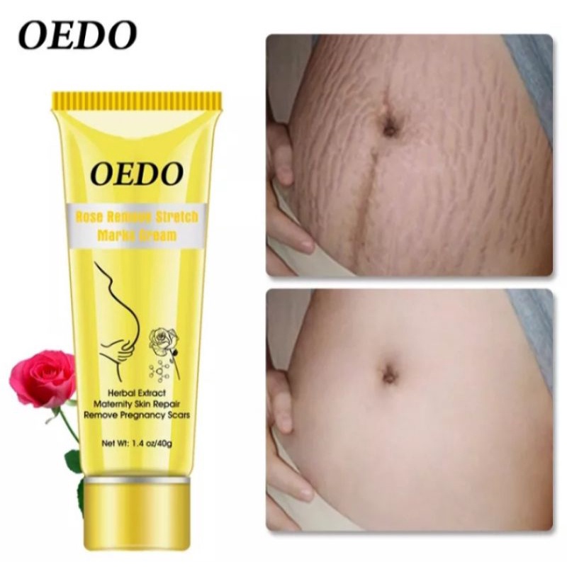 OEDO ROSE STRETCHMARK CREAM | CREAM PENGHILANG STRETCHMARK BEKAS LUKA HAMIL ANTI-AGING |