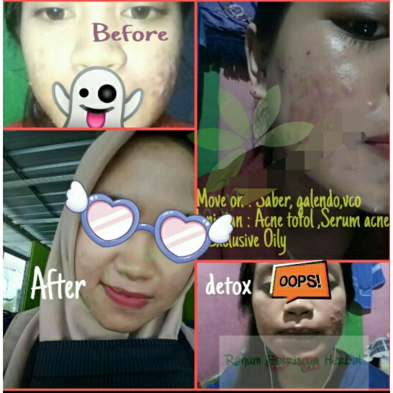 Batrisyia Herbal Acne cream totol jerawat besar meradang bruntusan