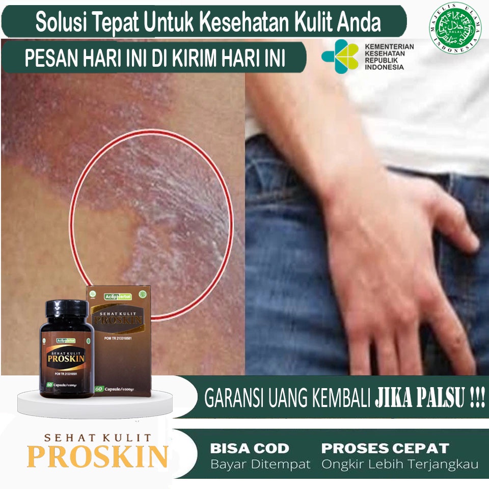 Obat Selangkangan hitam dan gatal, Obat Selangkangan jamuran, Obat Hitam selangkangan, Obat Selangka