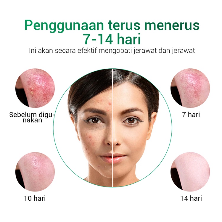 [Ori100%] Allphv Acne Treatment Cream Penghilang Jerawat Anti Acne Pimple Removal Spots Oil Control Shrink Pores Moisturizing Face Krim 20g Perawatan &amp; Kecantikan