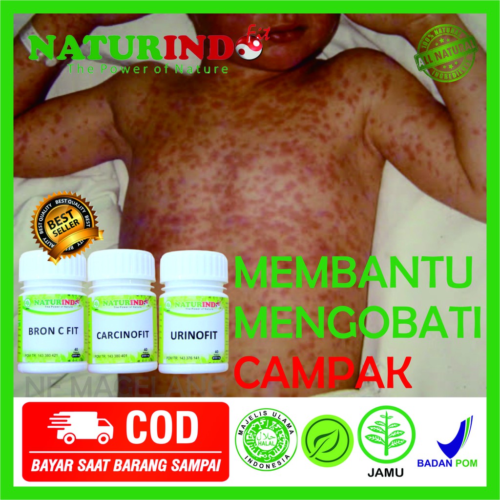 OBAT HERBAL ruam bintik merah pada kulit disertai gatal bintik merah gatal menyebar campak jerman