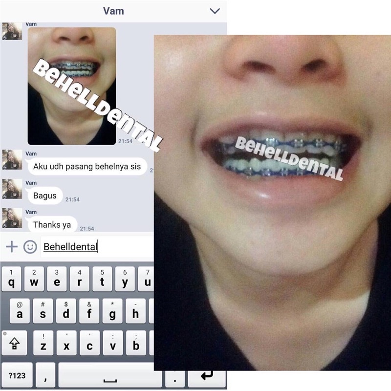 ORIGINAL BRACKET BEHEL GIGI METAL METALIC ORTHO FDA / AEGIS / GEOUSIS / LUXURY MINI ROTH MENGKILAP WITH HOOK on 3 - Dental Braces Orthodontic Untuk Perbaikan / Perawatan Gigi - Kawat - ANTI KARAT - Metalic