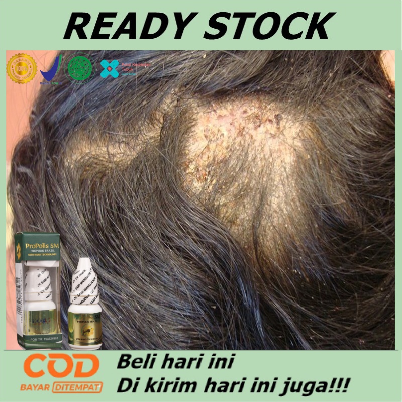 Obat herbal tinea kapitis, Obat psoriasis kulit kepala, Obat Tinea Kapitis Jamur di Kepala, Salep pe