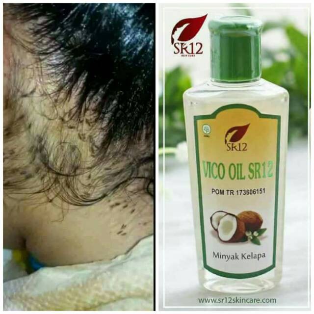 OBAT KUTU RAMBUT AMPUH VICO OIL SR12 OBAT KUTU RAMBUT OBAT KUTU RAMBUT ALAMI ORIGINAL