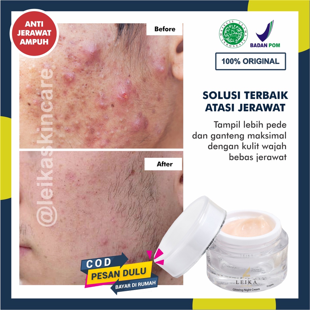 Krim Penghilang Jerawat Pria Cepat Aman BPOM Cream Penghilang Jerawat Ampuh Permanen Original Cream 