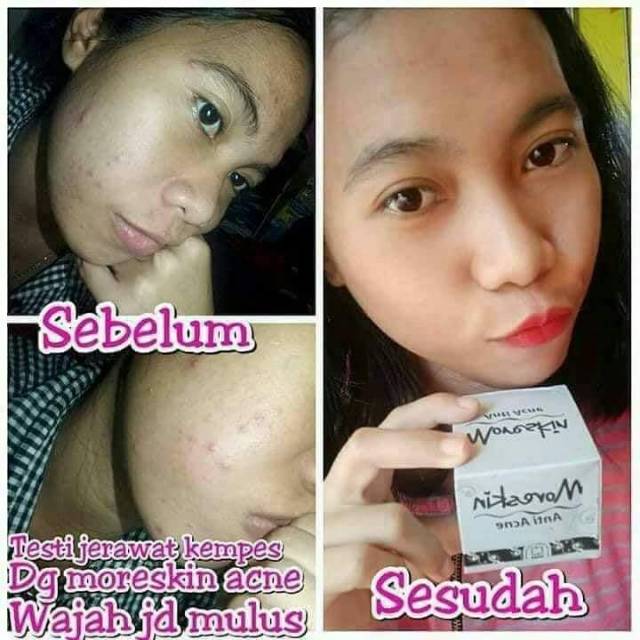 Moriskin Anti Acne Nasa