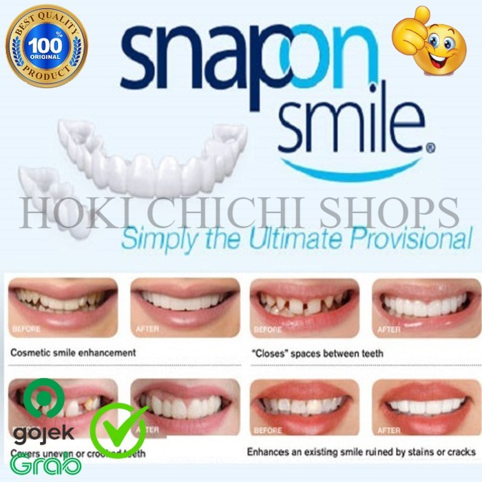 SET VENEER PELAPIS GIGI OMPONG - SEPASANG ATAS DAN BAWAH ORIGINAL CC