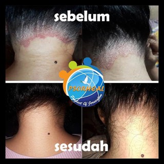 Pyderma Cream Adalah