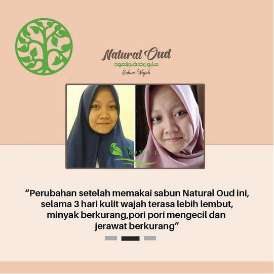 Sabun Penghilang Bopeng, Sabun Untuk Menghilangkan Bopeng, Penghilang Bopeng Menahun, Sabun Untuk Bopeng Parah, Penghilang Bopeng di Wajah, Sabun Penghilang Bopeng Bekas Jerawat Dengan Sabun Wajah Natural Oud Asli 100% Original BPOM dan Halal MUI