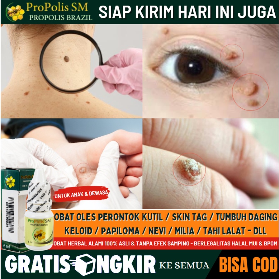 Obat Tetes Perontok Kutil / Tahi_Lalat / Skin Tag Aman Alami - Obat Penghilang Kutil di Wajah Tanpa 