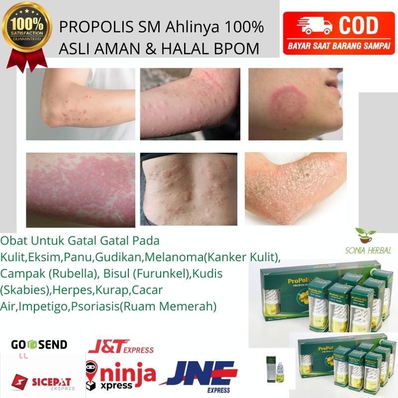 Obat Untuk Gatal Gatal Pada Kulit,Eksim,Campak,Bisul,Kubis,Jamur,Herpes,Kurap,Cacar Air-PROPOLIS SM