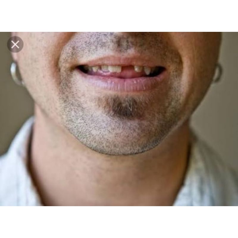 REMOVAL HAIR [PERONTOK BREWOK,KUMIS DAN