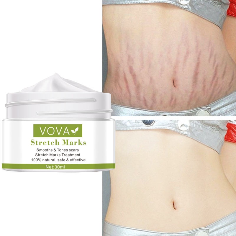 Krim Kehamilan Stretch Mark Cream 30ml Krim Penghilang Stretch Mark Paling Ampuh Untuk Ibu Hamil Setelah Melahirkan