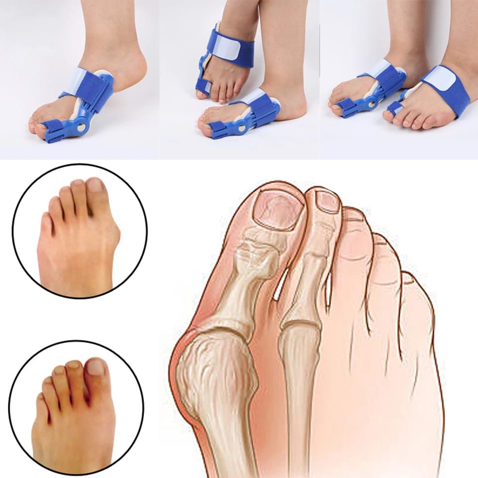 INSOLE KAKI BUNION DAN HALLUX VALGUS CORRECTOR KAKI BUNION INSOLE JARI KAKI BENGKOK TERAPI BUNION