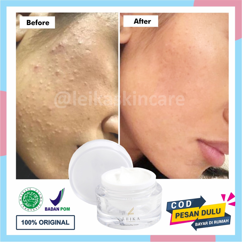 Paling Ampuh Krim Penghilang Bruntusan Di Wajah Cepat Aman BPOM Cream Penghilang Bruntusan Wanita Pe