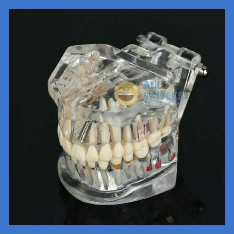 Dental model study gigi edukasi transparan studi implant phantom crown karies bridge bening