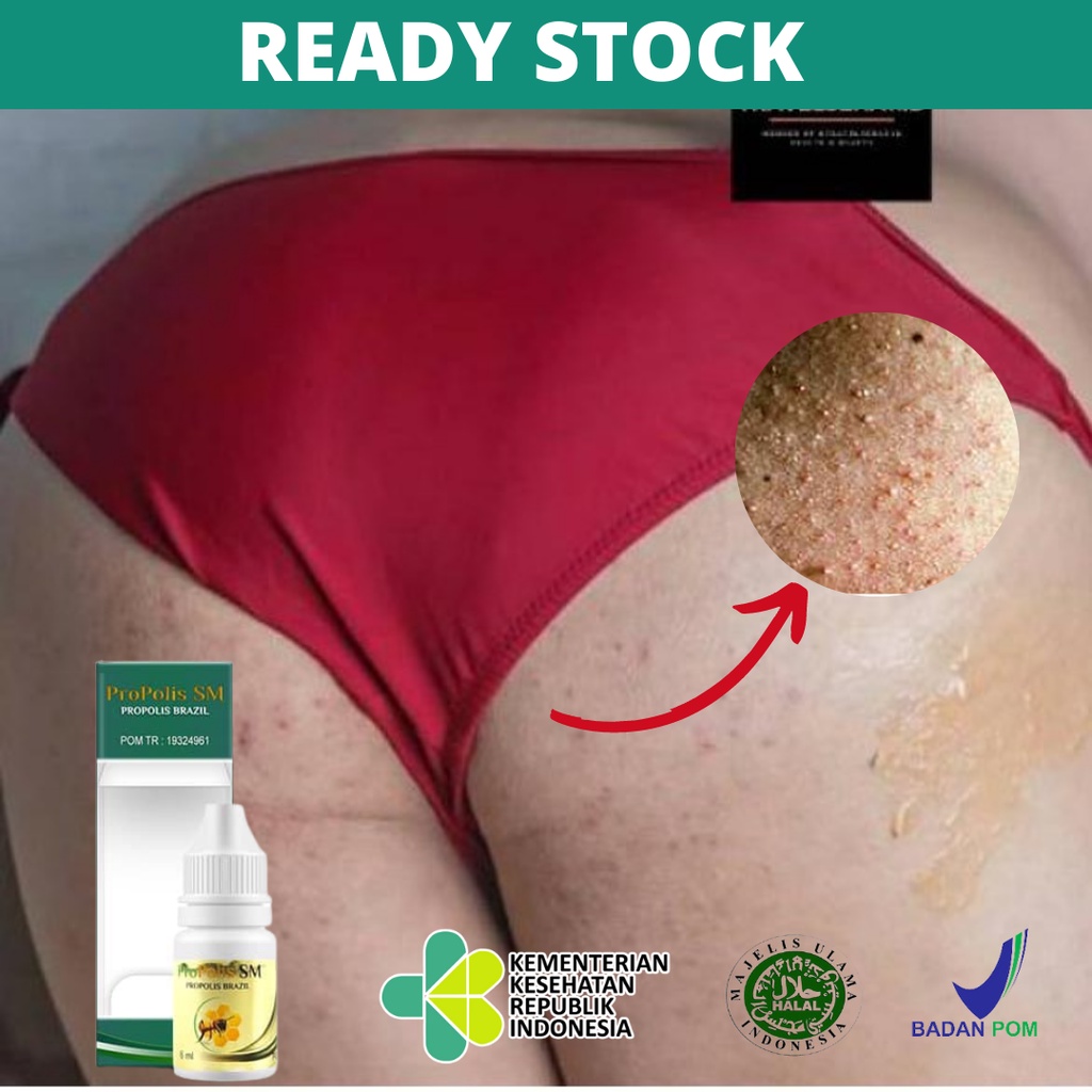 Obat Bruntusan di Pantat, Obat Pantat Gatal, Jerawat di Pantat, Menghilangkan Burik di Pantat, Obat 