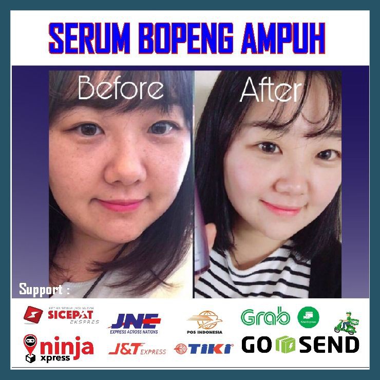 PENGHILANG BOPENG / BOPENG JERAWAT| CREAM BOPENG TRULUM AMPUH TERLARIS