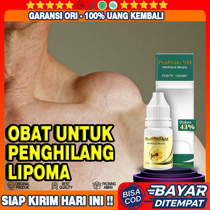 Obat Benjolan Lipoma, Penghancur Lipoma, Penghilang Lipoma, Benjolan