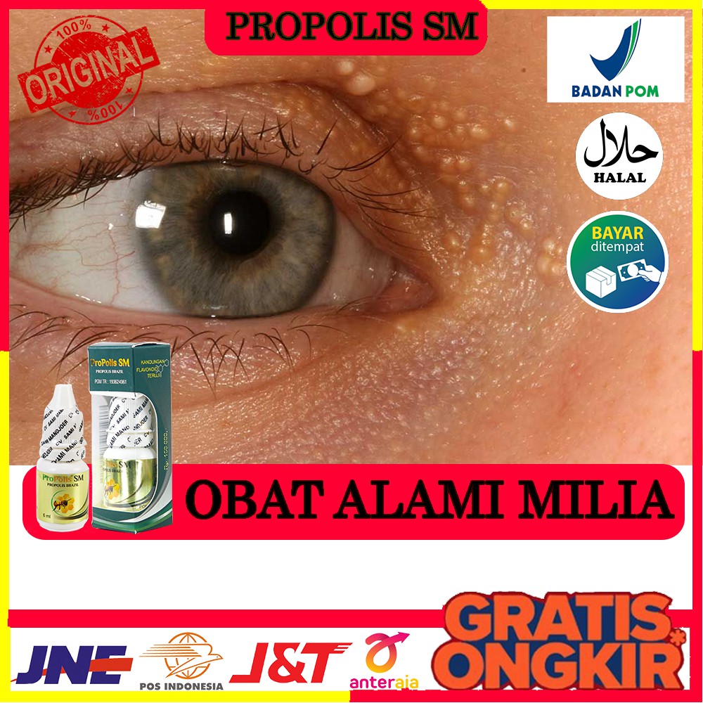 Obat Herbal Milia - Milia di Wajah - Milia di Kelopak Mata - Bintik Putih - Propolis Sm Solo - COD