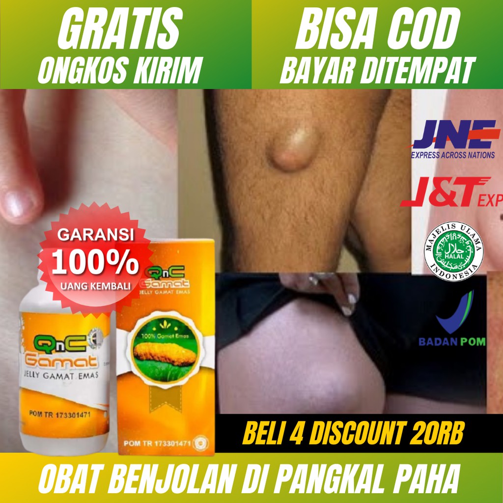 Obat Benjolan Di Pangkal Paha_Benjolan di Selangkangan_Hernia Femoralis Pria-Wanita_QnC Jelly Gamat