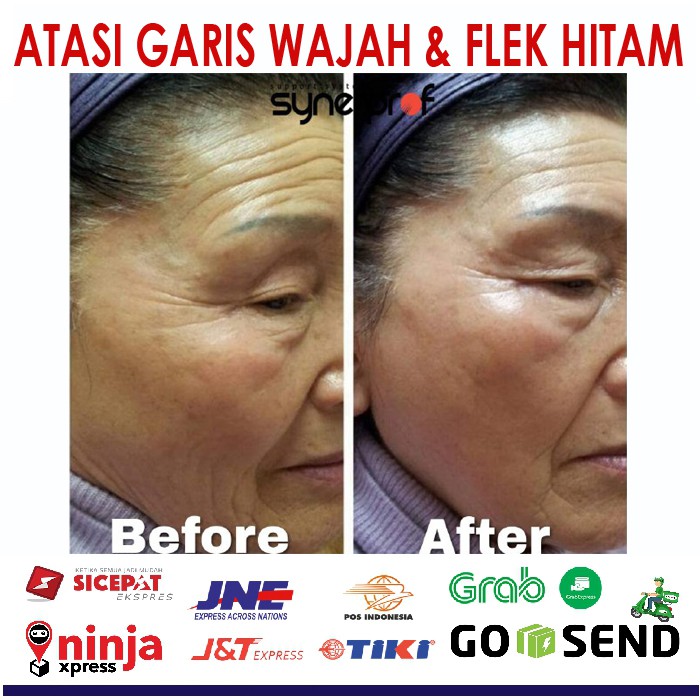 ☕JA‰© Krim Malam Yang Aman | Krim Untuk Menghilangkan Bopeng Bekas Cacar Air Yang Sudah Lama Trulum
