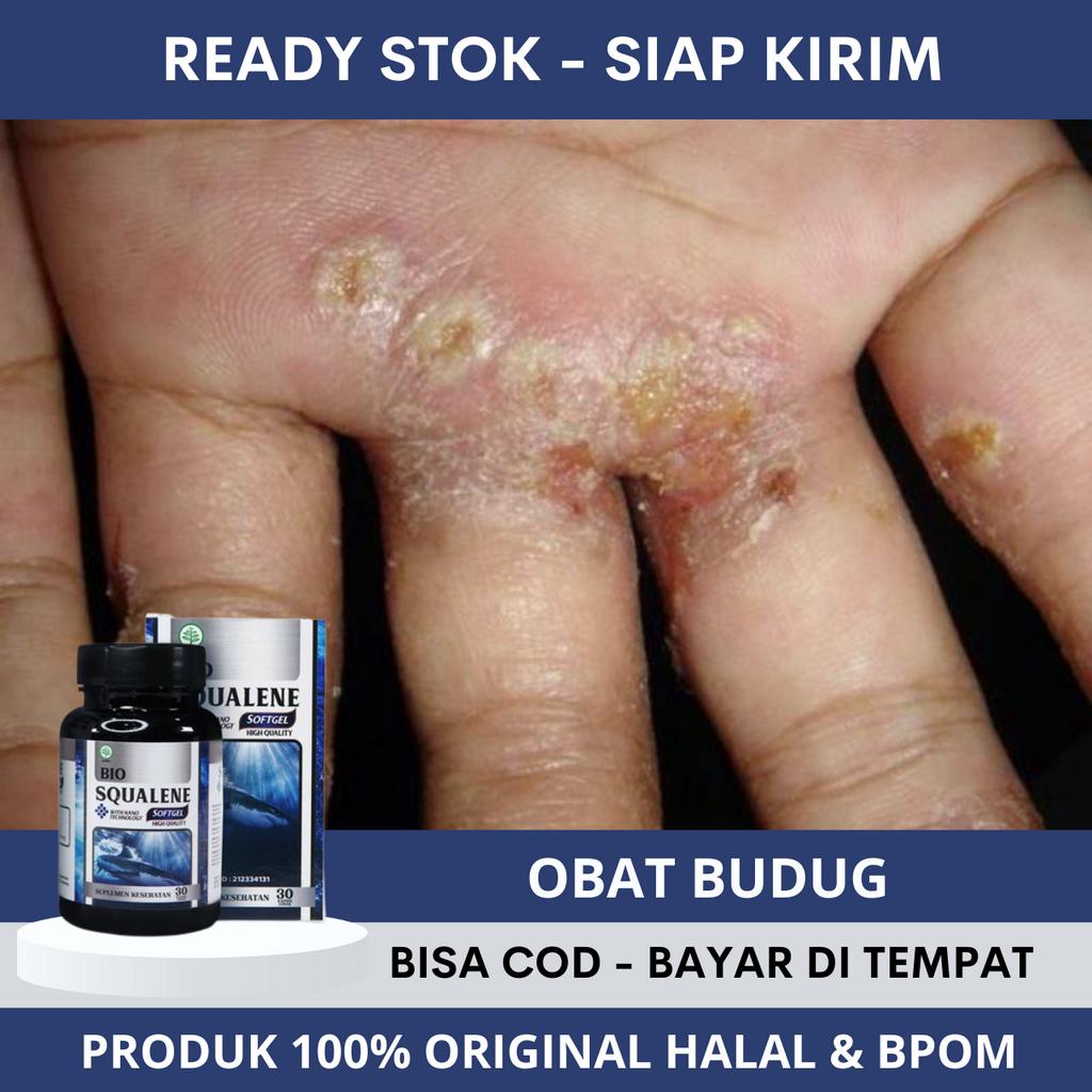 Obat Budug, Obat Budugan, Obat Budug Bernanah, Obat Buduk di Seluruh Tubuh, Obat Gatal Budug, Obat B