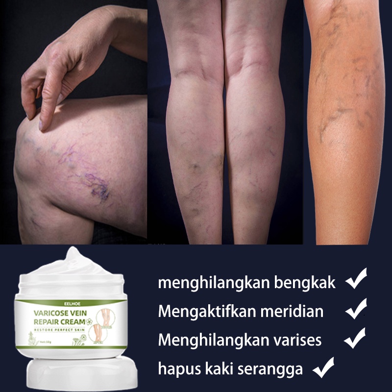 obat varises 50g Varises Obat Varises Paling Ampuh Pijat kaki untuk menghilangkan rasa sakit / mengeruk meridian / perawatan relaksasi vena dan krim perbaikan Bengkak Benjolan Vaskulitis Flebitis Pengobatan Vaskulitis