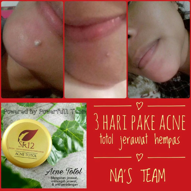 SR12 HERBAL SKINCARE ACNE TOTOL KRIM JERAWAT BPOM AMAN / MENGEMPESKAN JERAWAT / CREAM TUMPAS JERAWAT / PERAWATAN JERAWAT