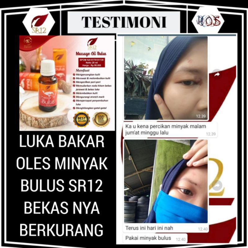 MINYAK BULUS SR12 OBAT GATAL KULIT DAN PEMUDAR BEKAS LUKA