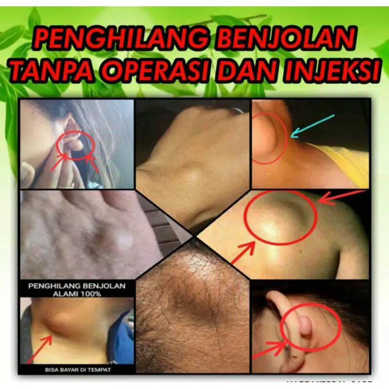 [BISA COD]CHITIN CHITOSAN PENGHILANG BENJOLAN, AMANDEL, BEKAS LUKA TANPA OPERASI ORIGINAL TIENS