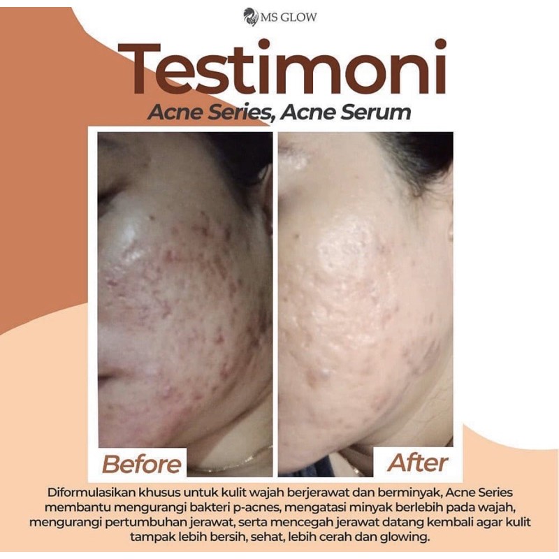 SERUM ACNE MSGLOW SERUM JERAWAT