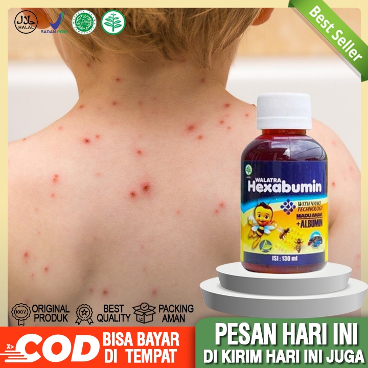 obat cacar air anak - obat untuk demam anak - obat untuk kesehatan anak walatra hexabumin asli bpom