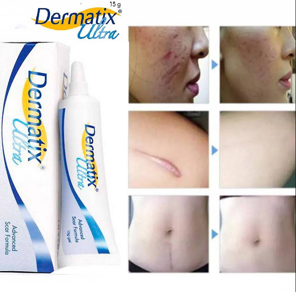 Dermatix Ultra Gel 15g penghilang bekas luka perawatan wajah penghilang bekas luka di kaki penghilan