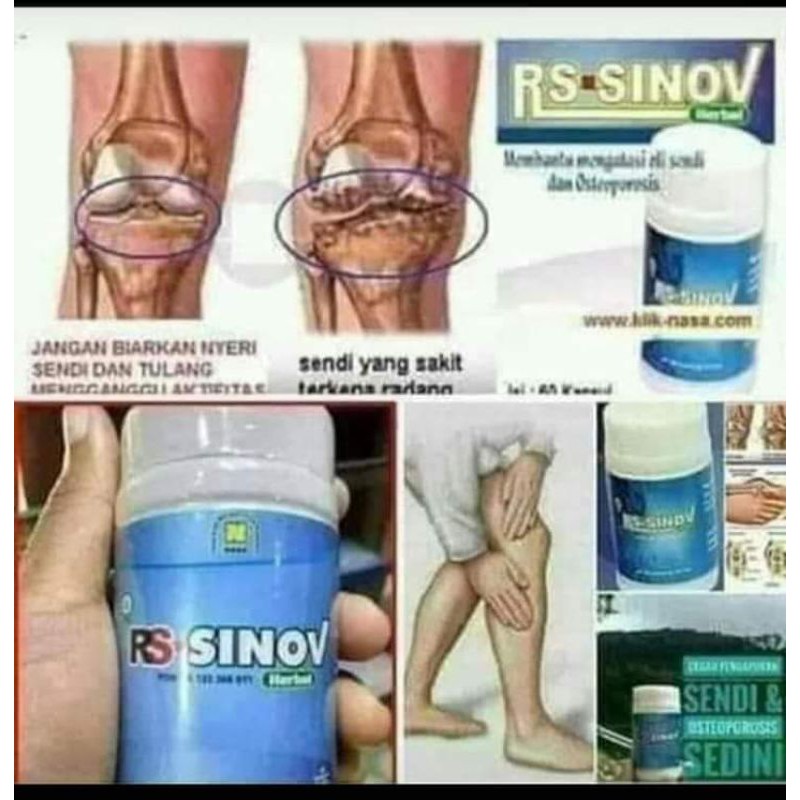 RS-SINOV Nasa Obat Herbal Mengatasi Masalah Sendi. RS-SINOV merupakan produk herbal alami(COD)