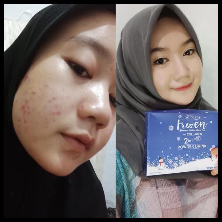 POWDER DRINK FROZEN COLLAGEN 2 IN 1 SKINISTA
