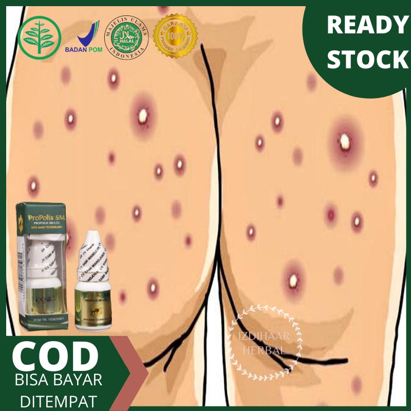 Obat Bisul di pantat, Obat gatal pantat, Obat jerawat pantat, Obat pantat burik, Obat Pantat gatal, 