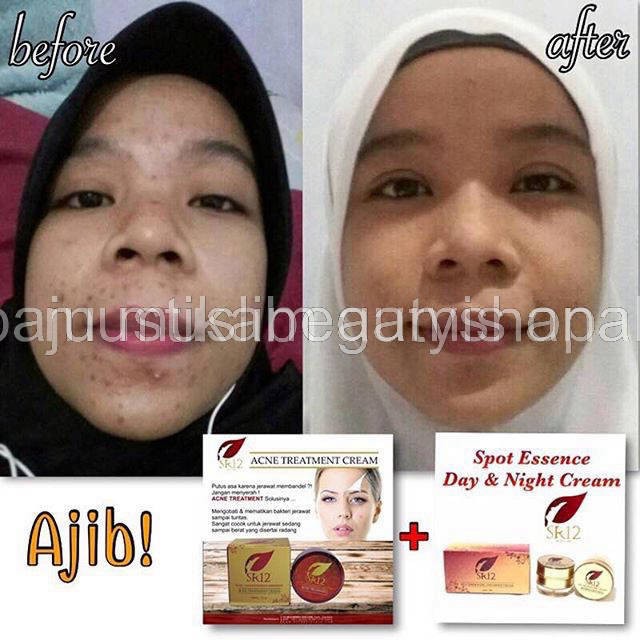 SR 12 KRIM JERAWAT ACNE  TOTOL - ACNE SERUM -ACNE MOISH- Toner acne  SR12 BPOM AMAN / MENGEMPESKAN JERAWAT / CREAM TUMPAS JERAWAT / PERAWATAN JERAWAT