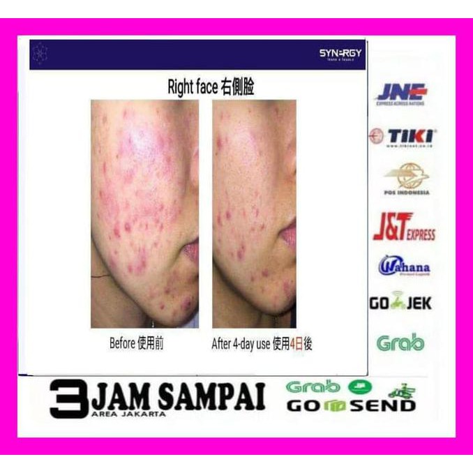 Hilangkan Bekas Jerawat Dengan Trulum | Trulum Solusi Awet Muda