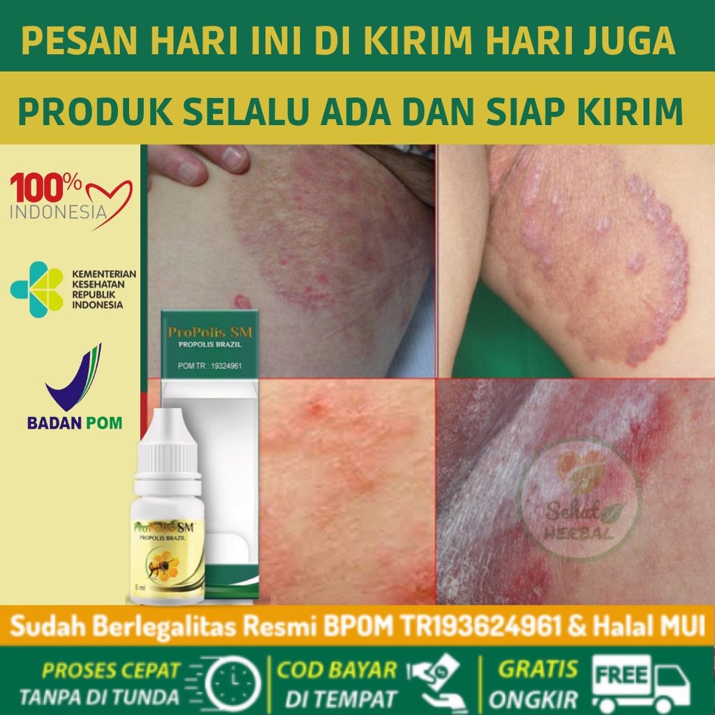 Jual Propolis Sm ASLI Original 100 Obat Gatal, Salep Kulit Gatal