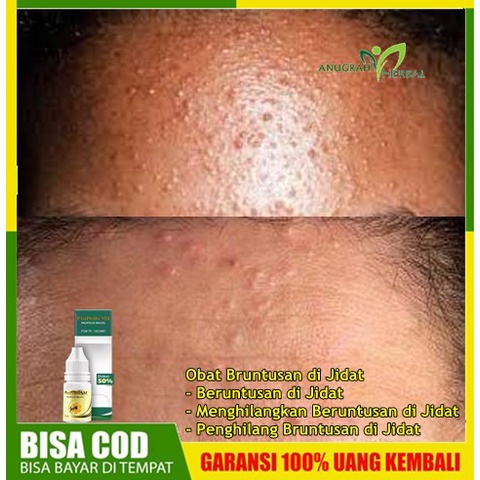 Obat Bruntusan di Jidat - Beruntusan di Jidat - Menghilangkan Beruntusan di Jidat - Penghilang Brunt