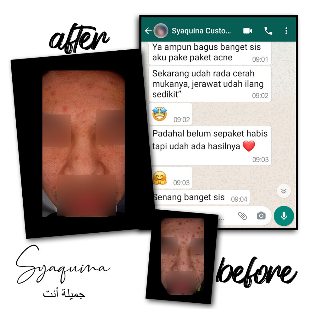 Syaquina Expert Paket Acne Series / Skincare Kulit Jerawat & Berminyak / Formulasi Dokter BPOM & MUI-4