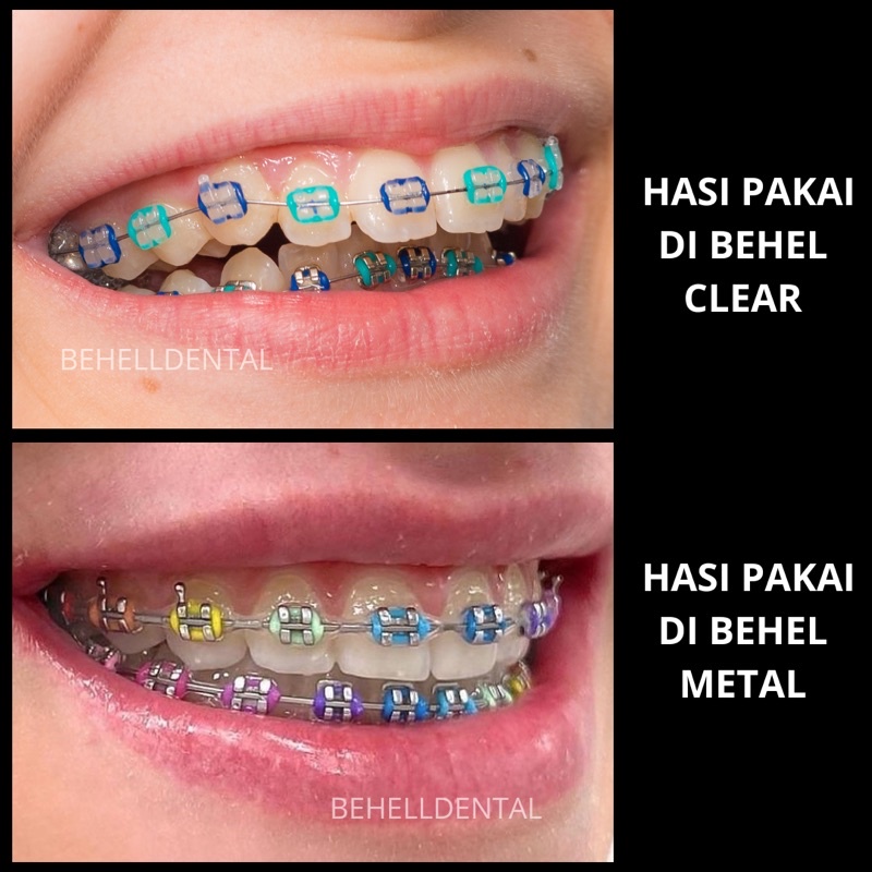 1 PACK ISI 40 PICS TEBAL KARET BEHEL MOTIF POWER O PREMIUM ORIGINAL Warna BABY BLUE / BIRU MUDA SOFT - Ligature Ties Tie - Dental Rubber Band Elastis Braces Ortho Orthodontik Orthodontics Kawat Gigi Behelldental