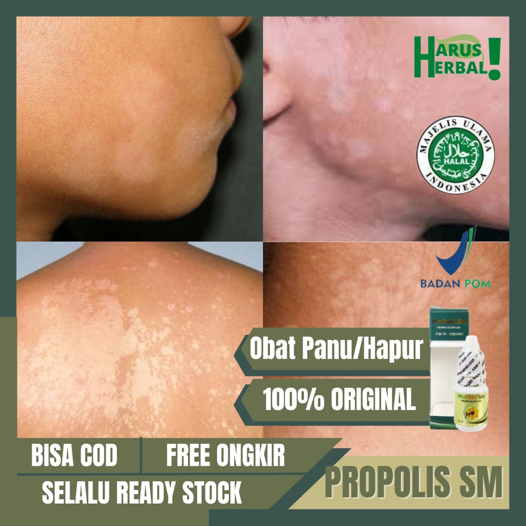 Obat Tetes Panu, Obat Penghilang Panu, Hapur, Balas Bogo, Obat Bercak Putih, Panu / Hapur Di Wajah, 